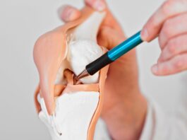 Lesione dei legamenti crociati anteriori: l’area dell’incisura femorale influenza l’outcome della riparazione? Lesione dei legamenti crociati anteriori: l'area dell'incisura femorale influenza l'outcome della riparazione?