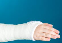 Fratture scomposte del polso nei bambini: spesso basta il gesso Fratture scomposte del polso nei bambini: spesso basta il gesso