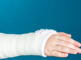 Fratture scomposte del polso nei bambini: spesso basta il gesso