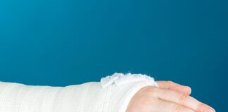 Fratture scomposte del polso nei bambini: spesso basta il gesso