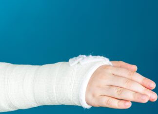 Fratture scomposte del polso nei bambini: spesso basta il gesso Fratture scomposte del polso nei bambini: spesso basta il gesso