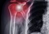 Spalla dolorosa, l’efficacia di un programma di allenamento per l’arto superiore Spalla dolorosa, l'efficacia di un programma di allenamento per l'arto superiore