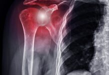 Spalla dolorosa, l'efficacia di un programma di allenamento per l'arto superiore