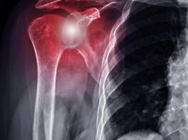 Spalla dolorosa, l’efficacia di un programma di allenamento per l’arto superiore Spalla dolorosa, l'efficacia di un programma di allenamento per l'arto superiore