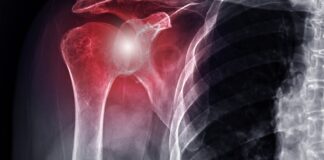 Spalla dolorosa, l'efficacia di un programma di allenamento per l'arto superiore