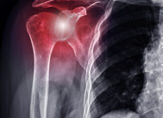 Spalla dolorosa, l'efficacia di un programma di allenamento per l'arto superiore