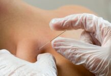 Dry needling, SIMFER: «Deve restare un atto esclusivamente medico» Dry needling, SIMFER: «Deve restare un atto esclusivamente medico»