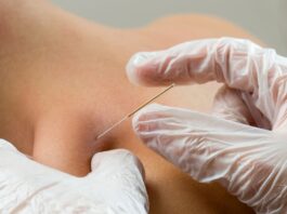 Dry needling, SIMFER: «Deve restare un atto esclusivamente medico» Dry needling, SIMFER: «Deve restare un atto esclusivamente medico»
