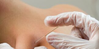 Dry needling, SIMFER: «Deve restare un atto esclusivamente medico»