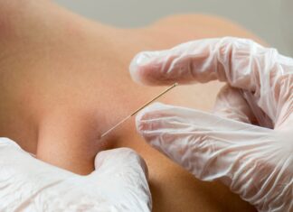 Dry needling, SIMFER: &laquo;Deve restare un atto esclusivamente medico&raquo;