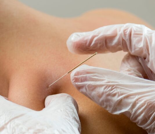 Dry needling, SIMFER: «Deve restare un atto esclusivamente medico» Dry needling, SIMFER: «Deve restare un atto esclusivamente medico»