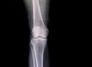 Frattura del piatto tibiale: come migliorare gli innesti ossei