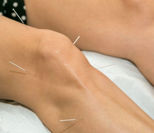 Artrosi di ginocchio: agopuntura tradizionale e con dry needling a confronto Artrosi di ginocchio: agopuntura tradizionale e con dry needling a confronto