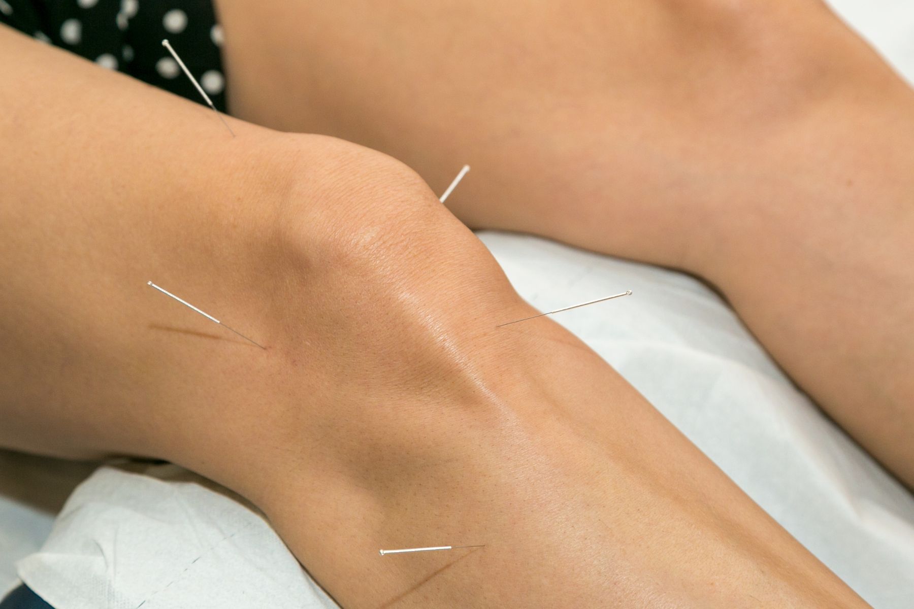 Artrosi di ginocchio: agopuntura tradizionale e con dry needling a confronto Artrosi di ginocchio: agopuntura tradizionale e con dry needling a confronto