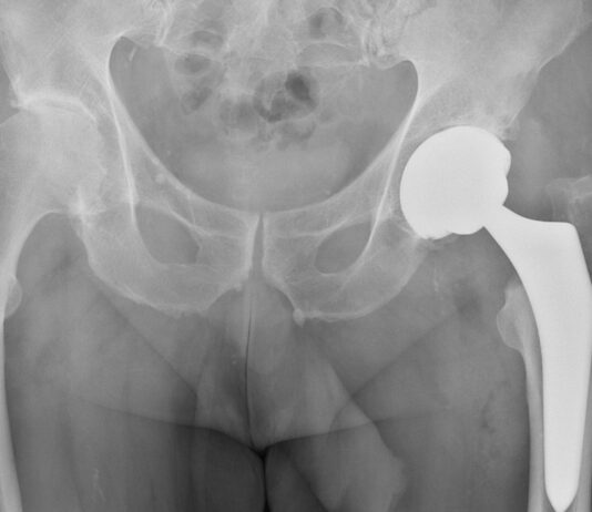 Artroplastica totale di anca: gli effetti sull'allineamento cinematico del ginocchio