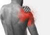 Come riconoscere una lesione alla cuffia dei rotatori