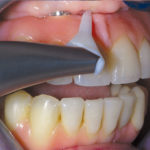 fig. 2 Utilizzo dei sistemi per il periopolishing per l’igiene della base protesica.