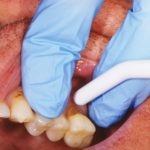 Fig-1-gestione-ipersensibilita-dentinale