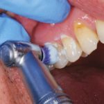 Fig-2-gestione-ipersensibilita-dentinale