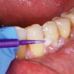 Fig-3-gestione-ipersensibilita-dentinale