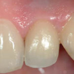 Monoelemento-protesizzato