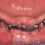 Overimplant-su-barra