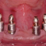 Overimplant-su-bottoni