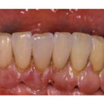 Protesi-fissa-rimovibile-su-impianti