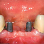 Protesi-intercalata-con-monconi-esposti