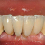 Protesi-intercalata-protesizzata