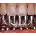 Struttura-in-metallo-su-impianti