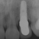 radiografia-di-controllo