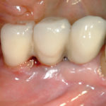 Mucosite-perimplantare