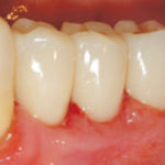 Mucosite-perimplantare-2