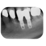 perimplantare-immagine-radiografica