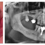 granuloma-periferico-a-cellule-giganti