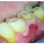 granuloma-periferico-a-cellule-giganti-2