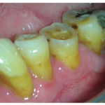 granuloma-periferico-a-cellule-giganti-3