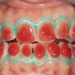 Applicazione-del-prodotto-sbiancante-sulla-superficie-vestibolare-dei-denti-da-trattare.