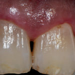 erosione-dentale_1