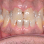 erosione-dentale_1b