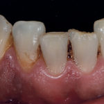 erosione-dentale_2