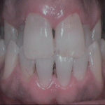 erosione-dentale_3a