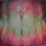 erosione-dentale_3b