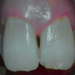 erosione-dentale_3c
