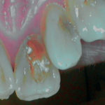 erosione-dentale_3d