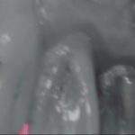 erosione-dentale_3e
