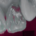 erosione-dentale_3f