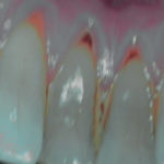 erosione-dentale_3g