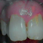 erosione-dentale_3h